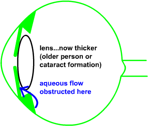 later anterior chamber narrows and aqueous obstructed
