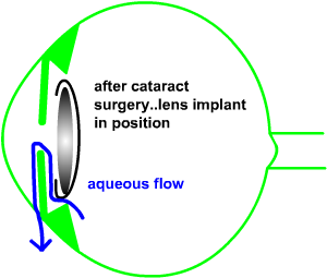 cataract surgery is one of the treatments of angle closure glaucoma