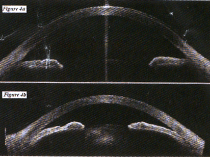an ultrasound photo of the anterior chamber (Ophthalmology International)