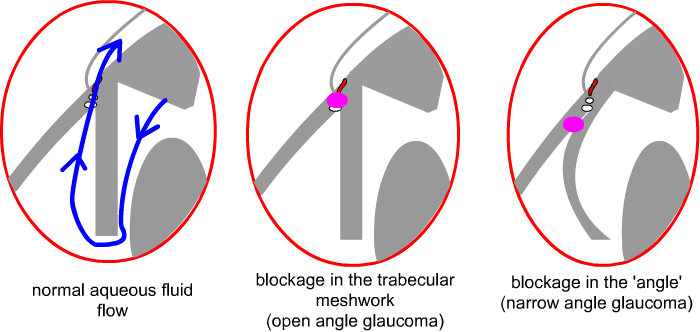 site of blockage and glaucoma
