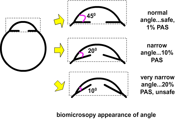 narrow angles deomonstrated by ultrasound; they may gradually close