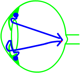 aqueous flow in angle closure glaucoma