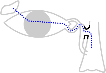 a DCR operation creates a channel from the tear sac into the nose