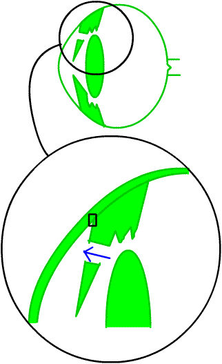 a close up diagram of the iridotomy