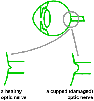 a healthy optic nerve and a cupped damaged optic nerve