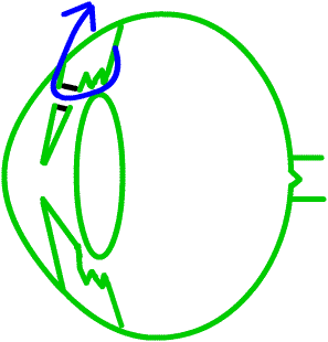 iridotomy...the treatment of acute glaucoma