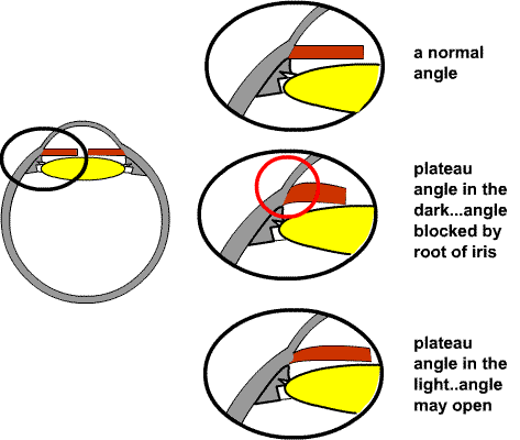 diagram of plateau iris