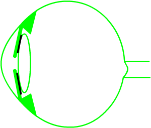 irido-lens contact is the start of the angle closure