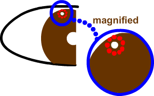 argon laser a ring around the pi brfore the yag laser