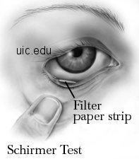 schirmers tear test (Uic.edu)