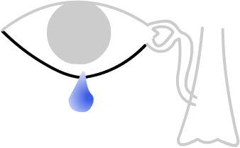 an ectropian of the lower eyelid can cause a watery eye