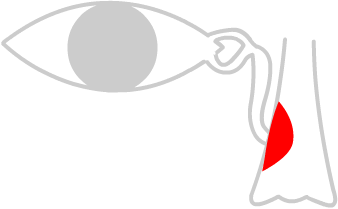disease in the nose may cause a watery eye
