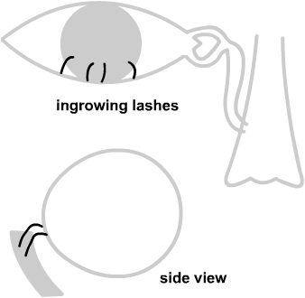 ingrowing eyelashes may cause a watery eye