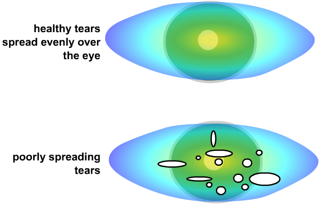 poorly spreading tears cause a sore eye