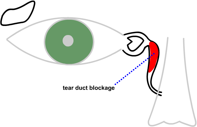 a blocked tear duct...between the eye and the nose