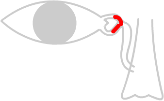 a blocked common canaliculus cause a watery eye