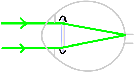 posterior capsulotomy after laser