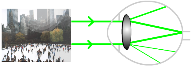 light scatter with cataract