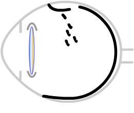 floaters after laser capsulotomy