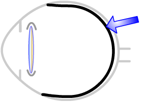retina after laser capsulotomy