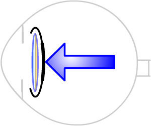 thickened posterior capsule