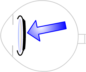 thickened posterior capsule