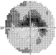 arcuate scotoma: www.aafp.org