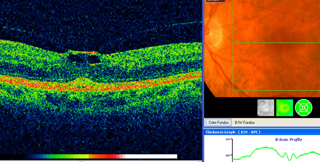 vitreo-macular traction