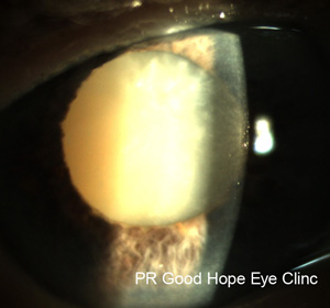 mature cataract...very dense with very poor vision.