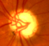 glaucoma cupping