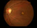 best macular dystrophy