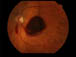 best macular dystrophy