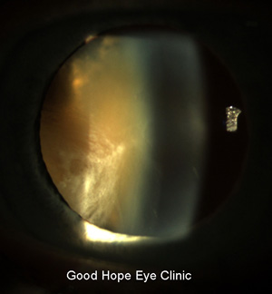 cataract...nuclear sclerosis