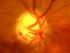 retinal vein  occlusion & glaucoma