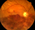 retinal vein  occlusion & glaucoma cupping