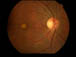 best macular dystrophy