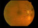 best macular dystrophy
