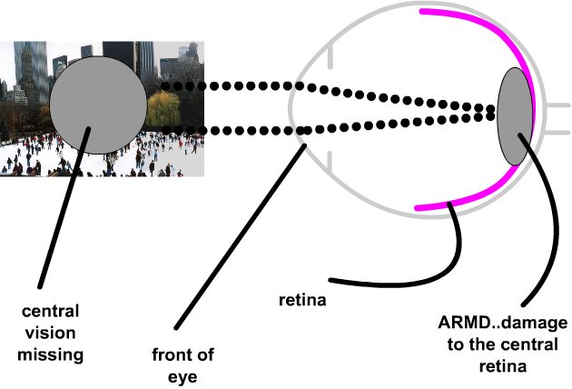 central vision is lost in ARMD