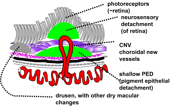 occult cnv (occult type of wet ARMD)