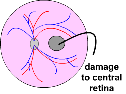 diagram of macular damage