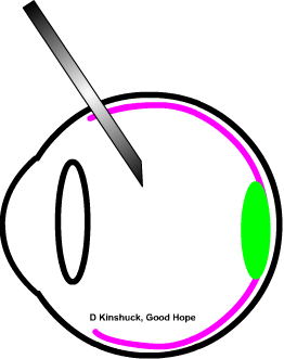 diagram of lucentis intravitreal injection