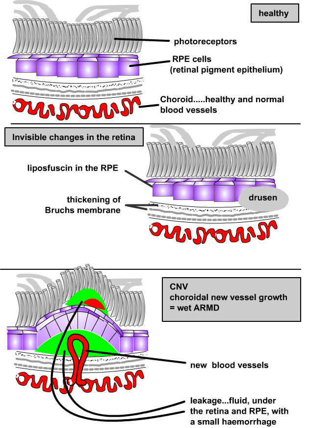 diagram of wet armd developing