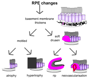 patterns of retinal pigment epithelial damage