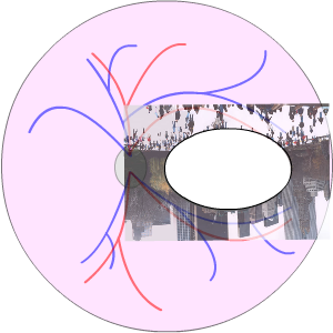 scotoma with macular degeneration