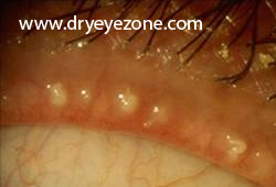 blocked meibomian glands