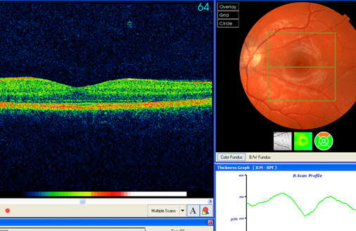 an oct showing speckles in the foveal area (better seen on photo below)