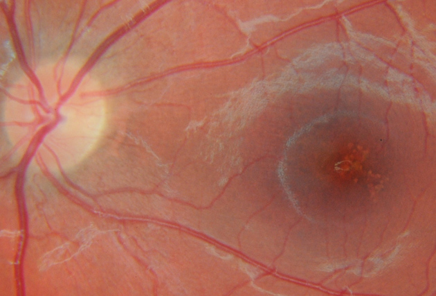a photograph showing speckels at the fovea