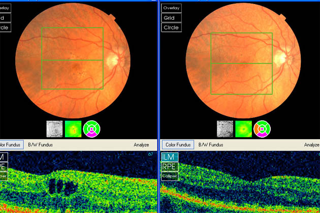 early cnv right eye