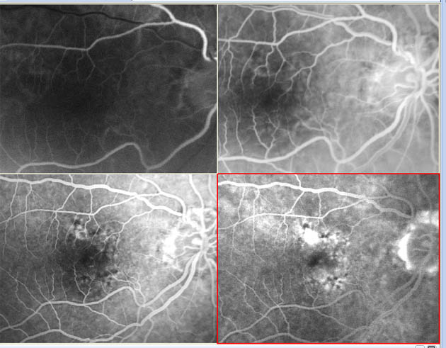 early classic cnv right eye