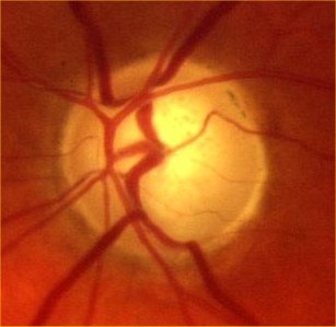 a cupped disc in chronic glaucoma 0.85 c/d